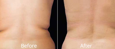 Coolsculpting in Chesapeake at Chesapeake Vein and MedSpa